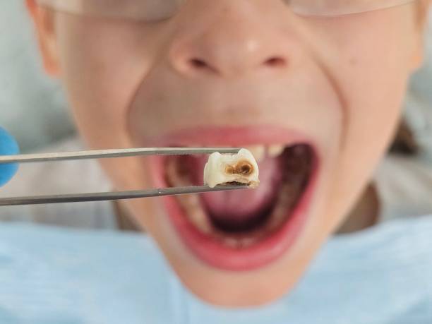 Best Root Canal Emergency Dentist  in Midfield, AL